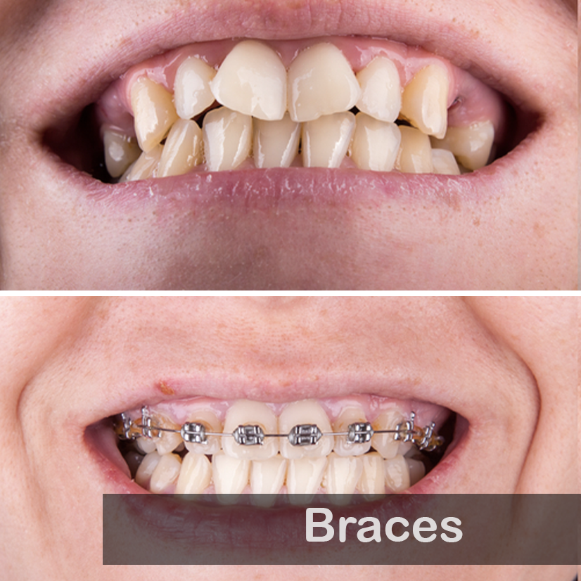 Braces 02