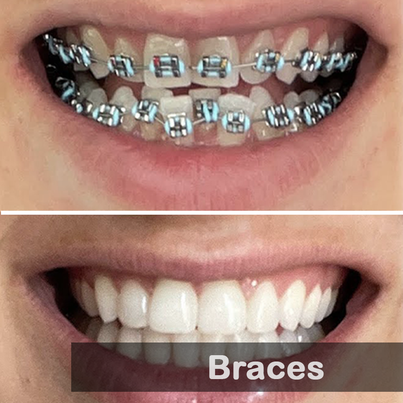 Braces 03-1