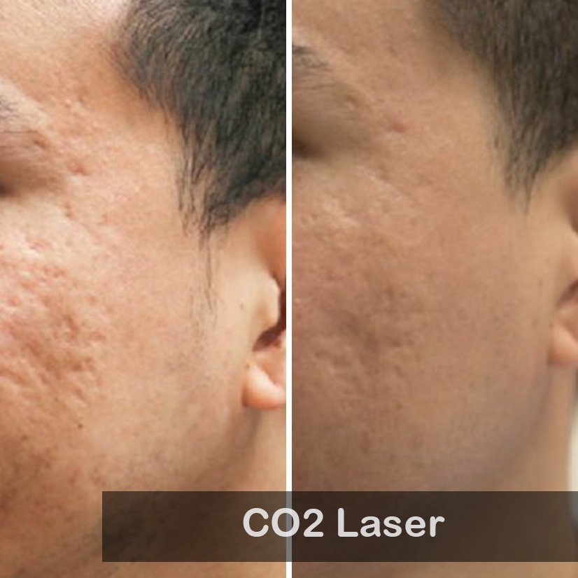 CO2 Laser