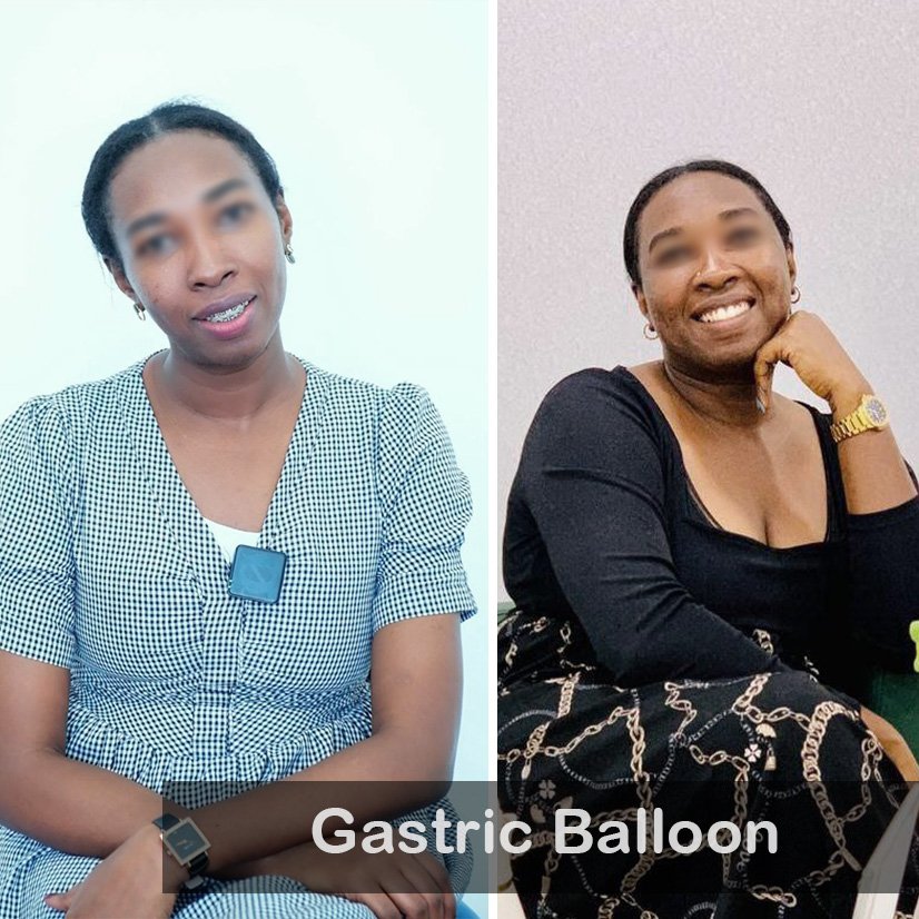 Case 04 Gastric Balloon