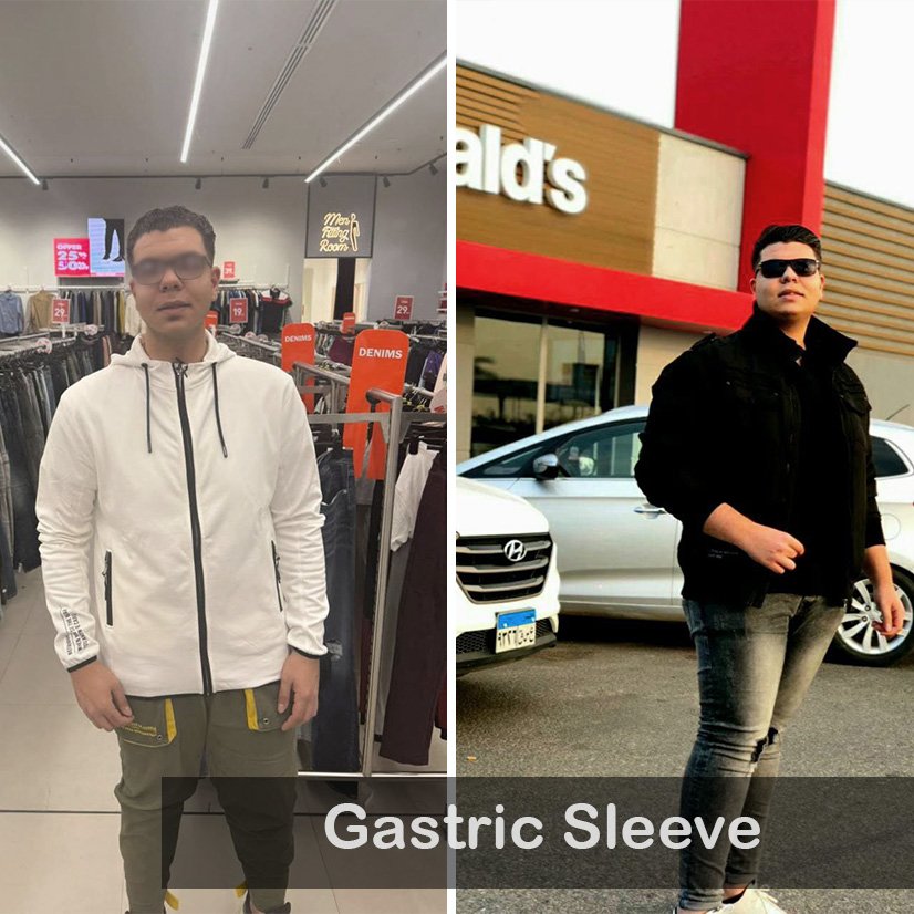 Case 05 Gastric Sleeve_