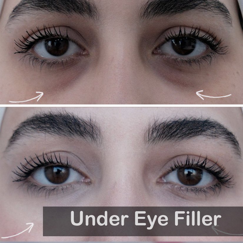 Case 06 under eye filler