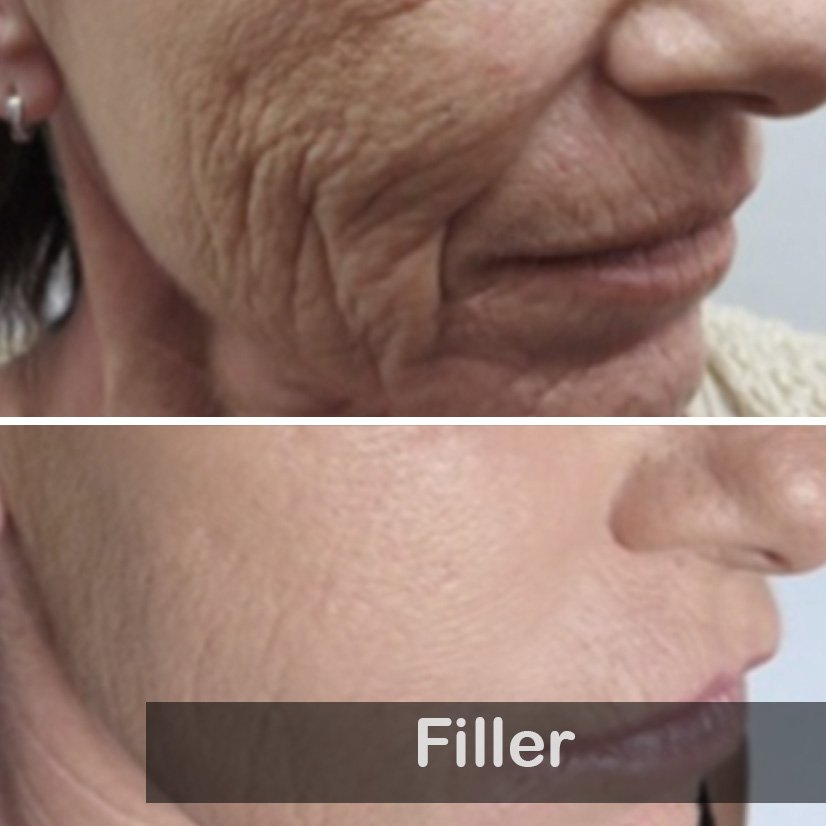 Derma Filler