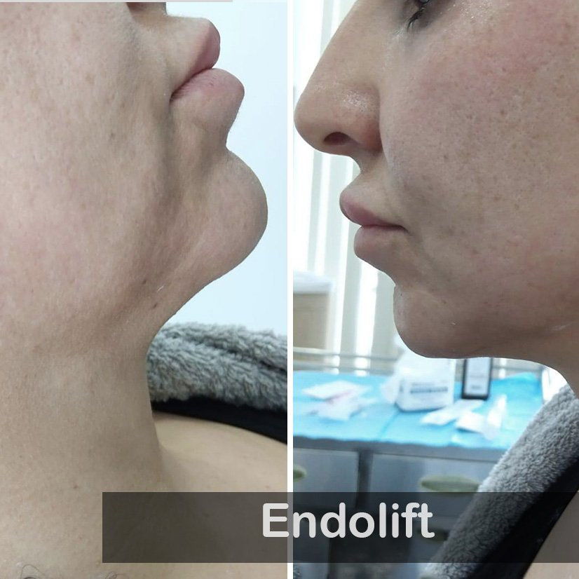 Endolift casae 04
