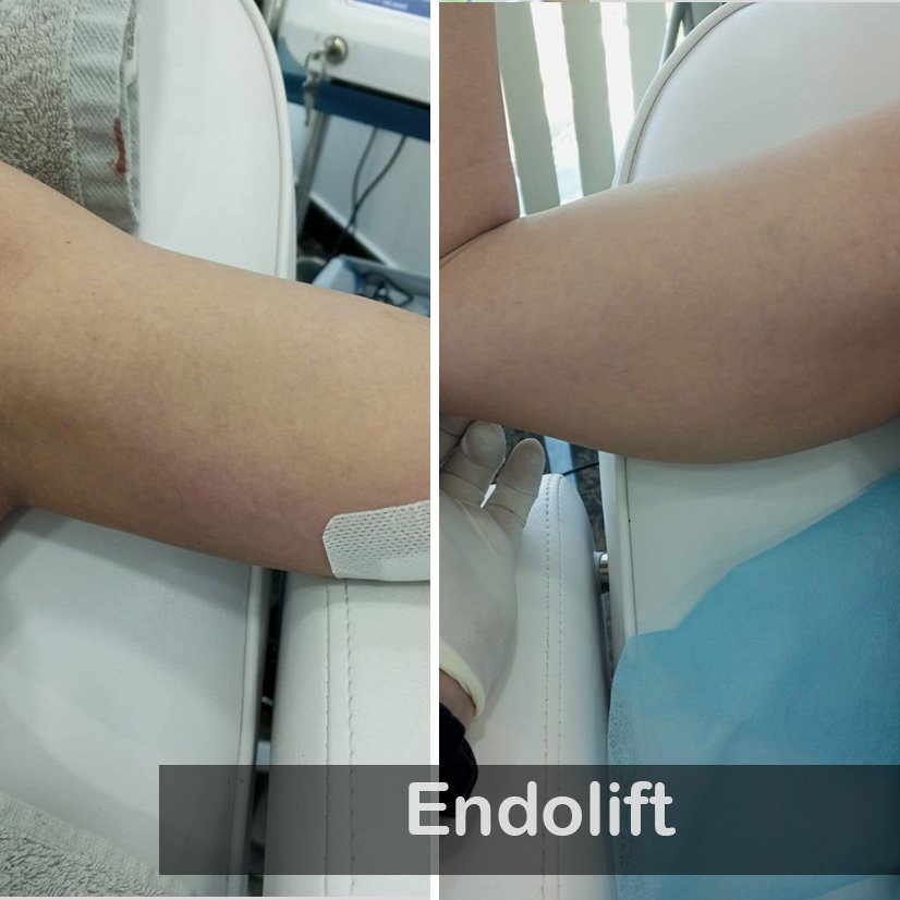 Endolift case 03