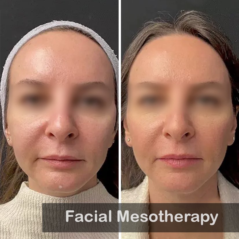 Facial Mesotherapy_