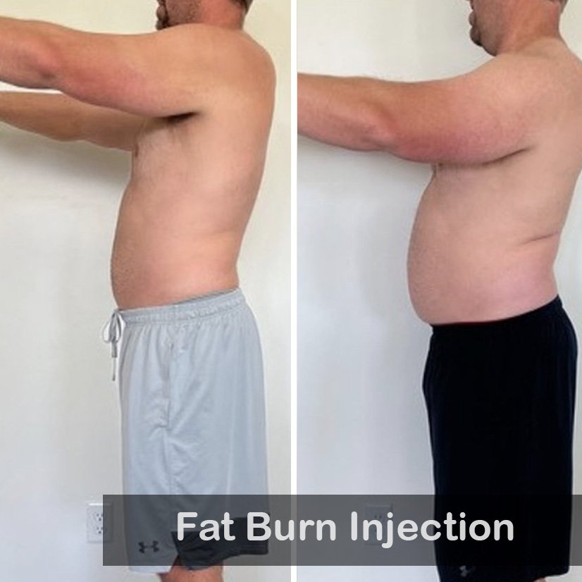 Fat Burn Injection-1