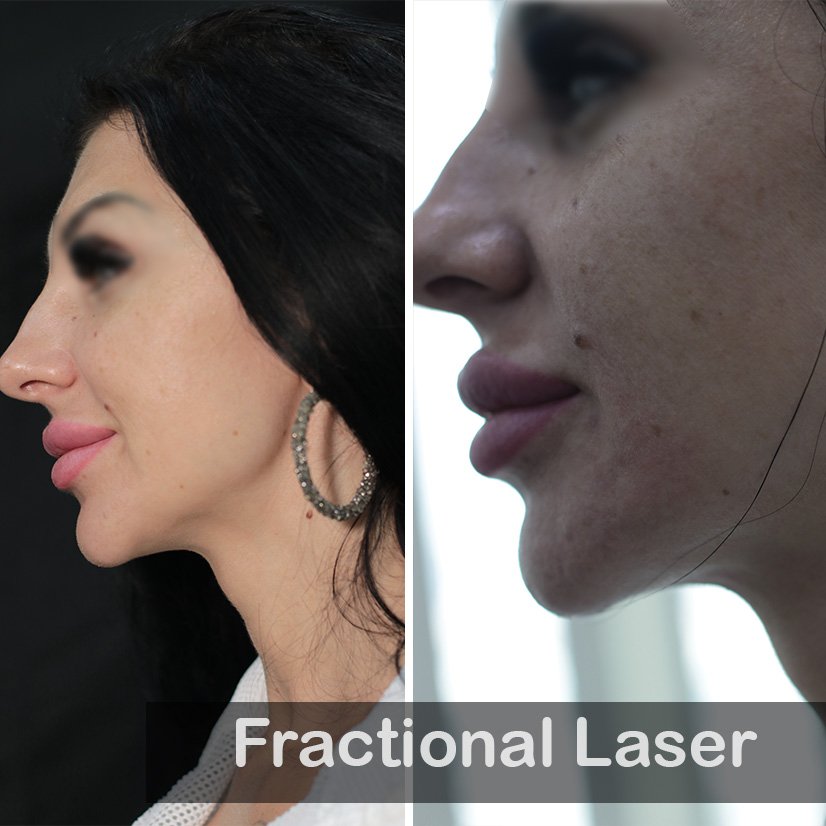 Fractional Laser