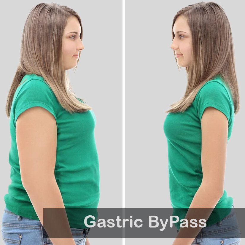 Gastric ByPass_