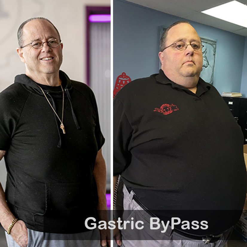 Gastric Bypass