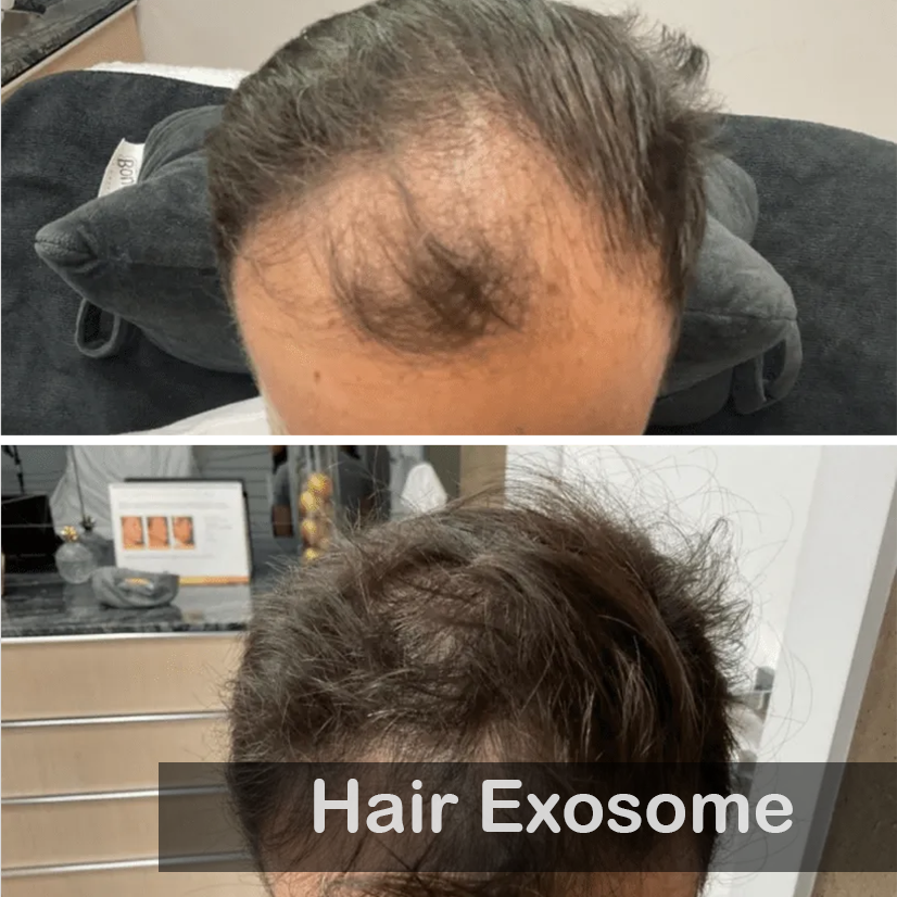 Hair Exosome