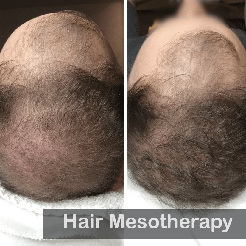 Hair Mesotherapy-1