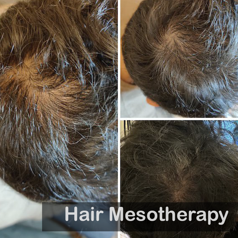Hair Mesotherapy