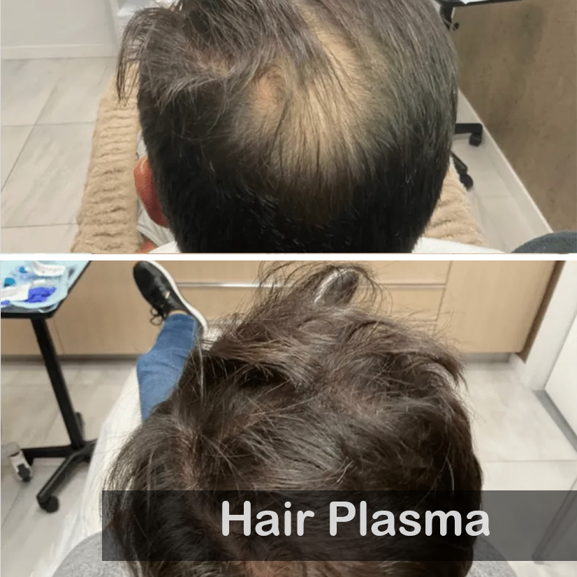Hair Plasma