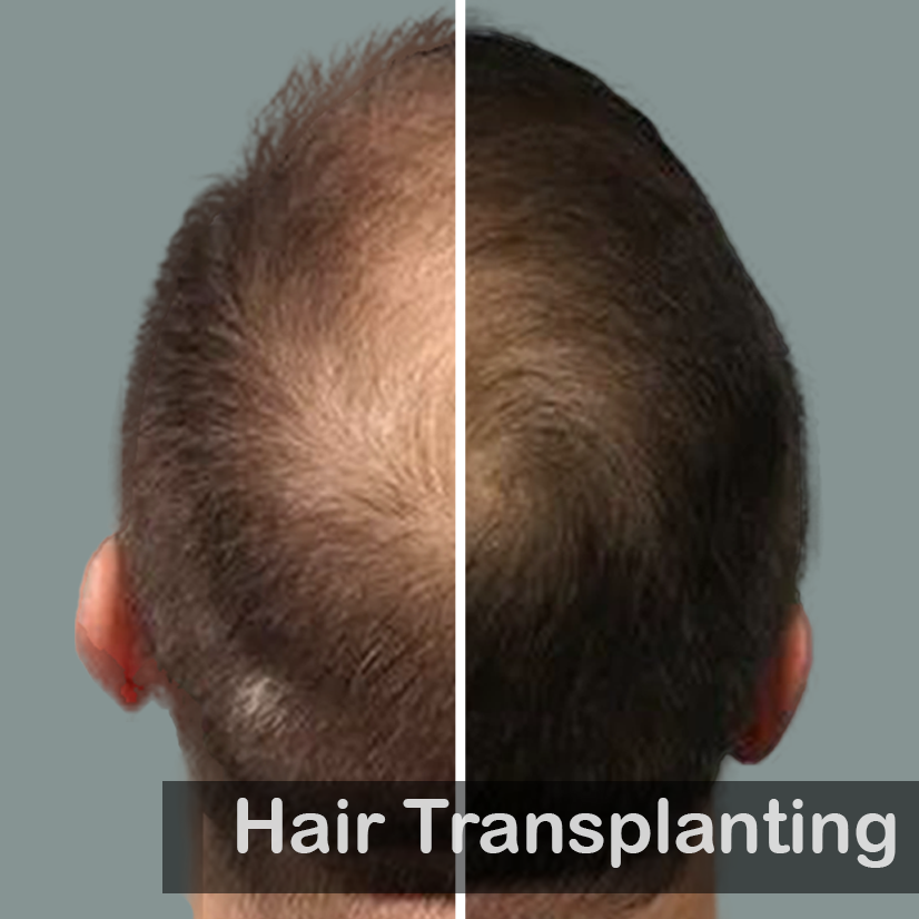 Hair Transplanting