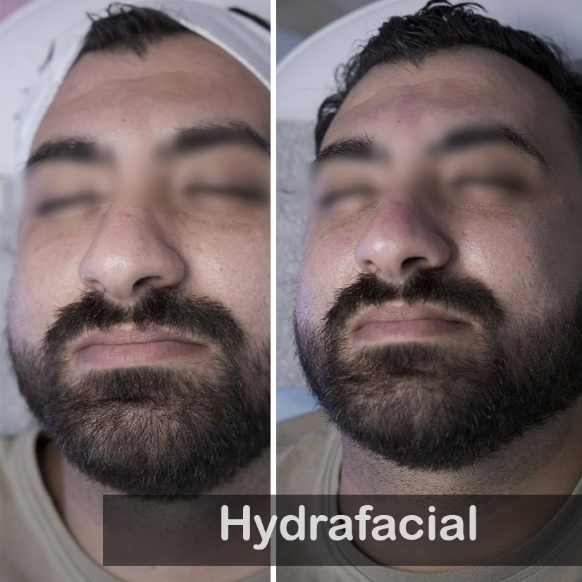 Hydrafacial