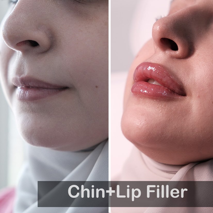 Lip & Chin Filler_