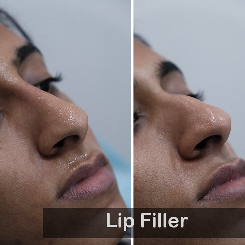 Nose Filler_
