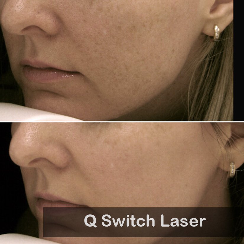 Q Switch Laser-1