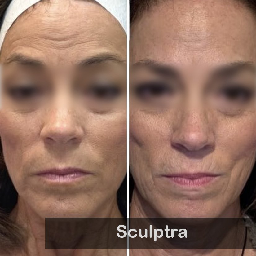 Sculptra 01