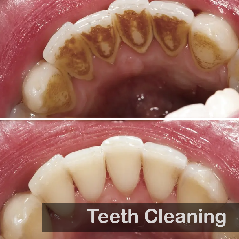Teeth Cleaning 01
