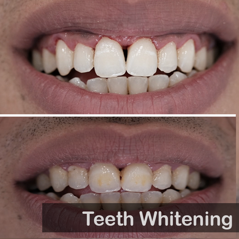 Teth Whitening