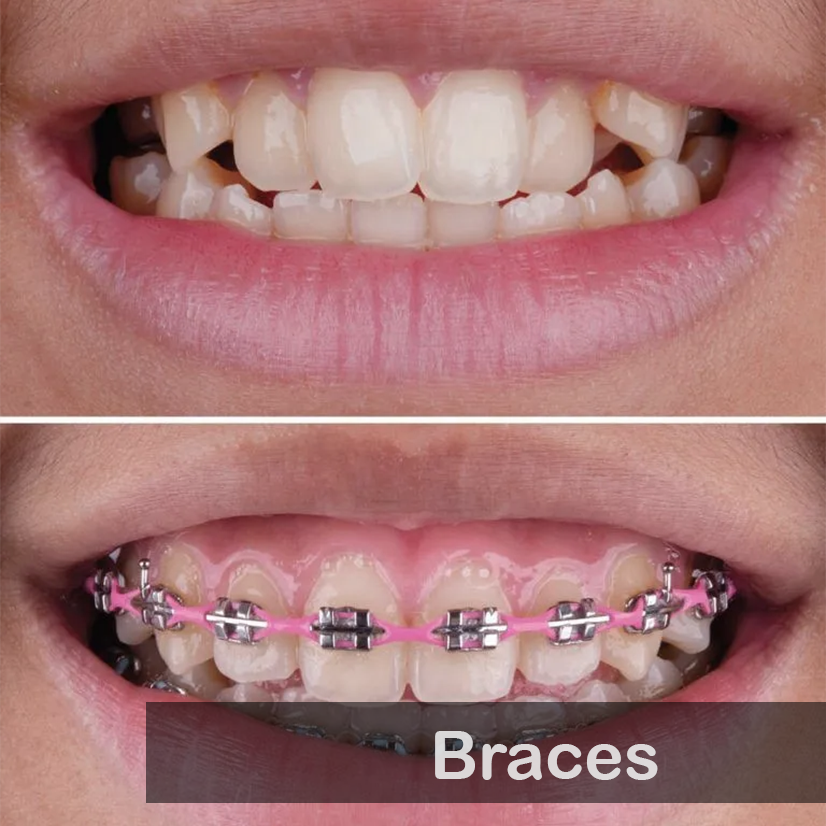 braces 03
