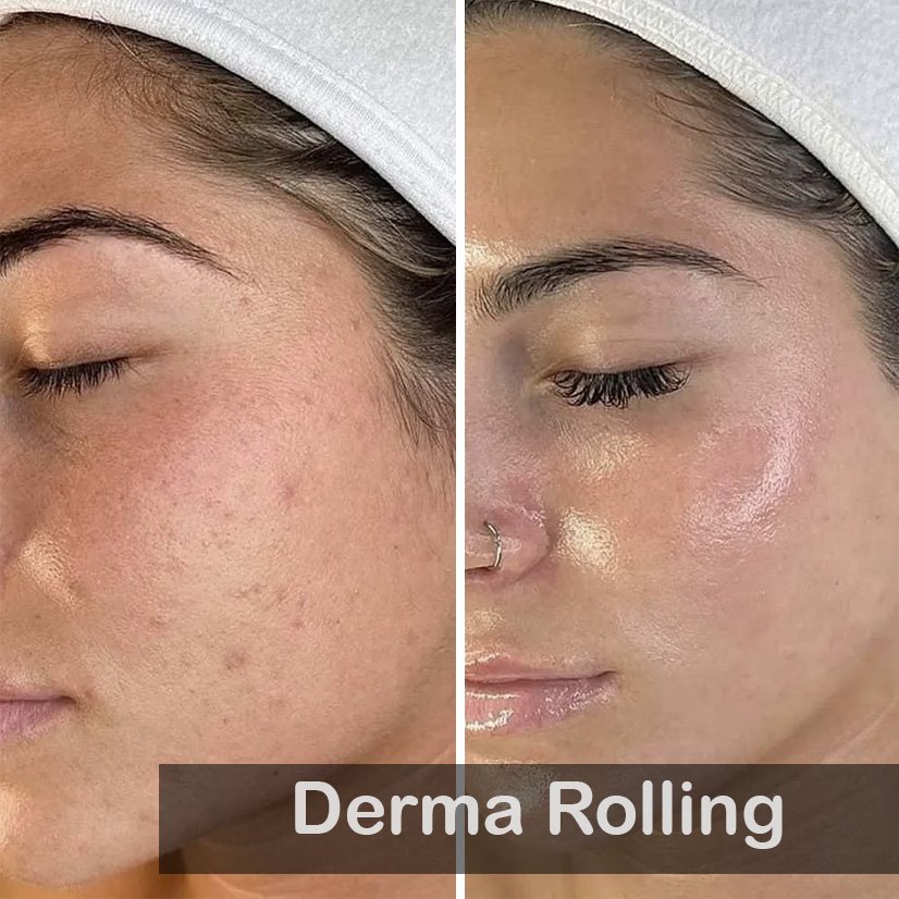 derma Rolling