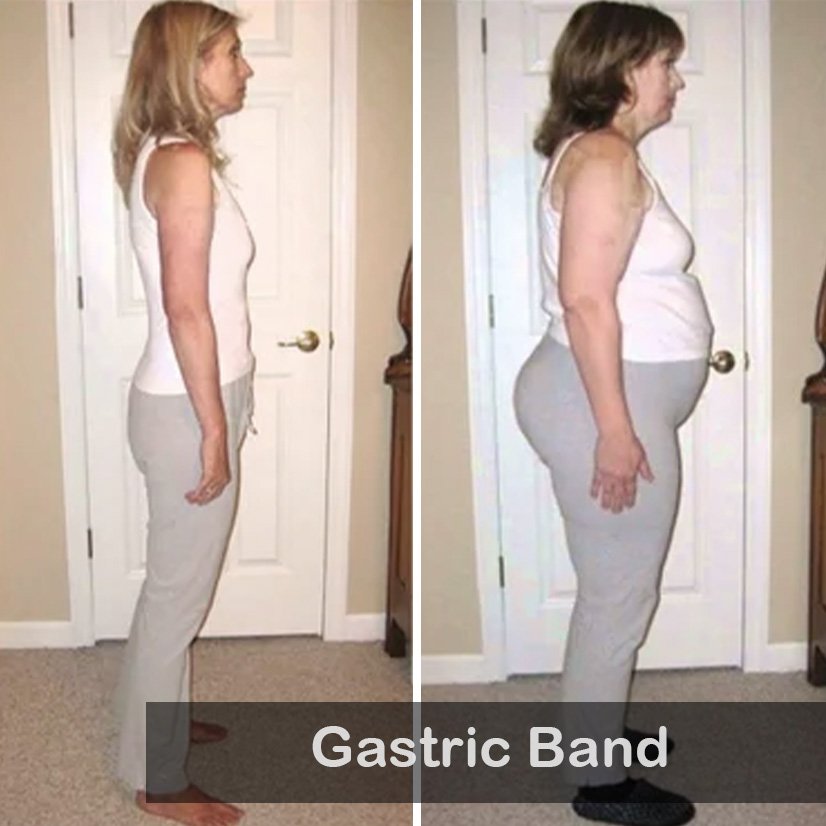 gastric band