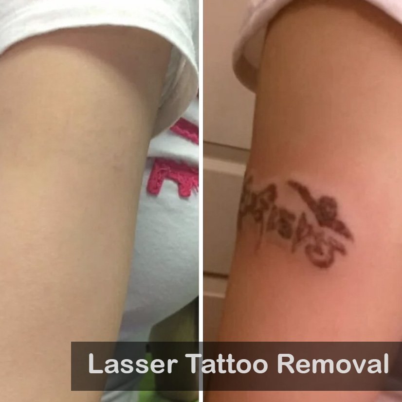 laser Tattoo removal-1