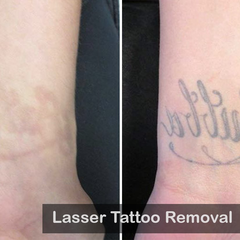 laser Tattoo removal