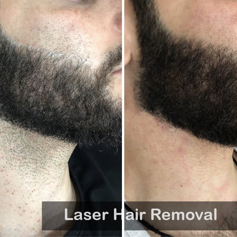 laser hair removal-1