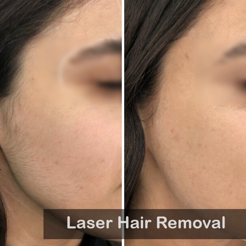 laser hair removal