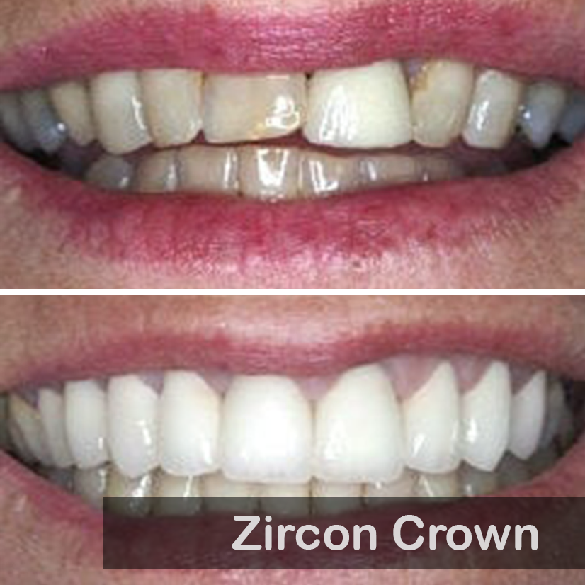 zirconia 01