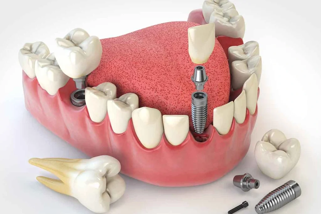 مركز زراعة الأسنان في الامارات