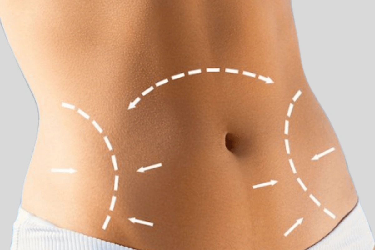 أفضل مركز ابر تذويب دهون البطن في دبي