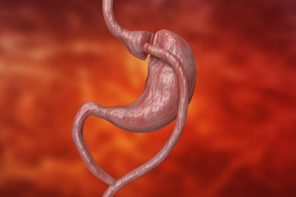 عملية تحويل مسار المعدة في الامارات