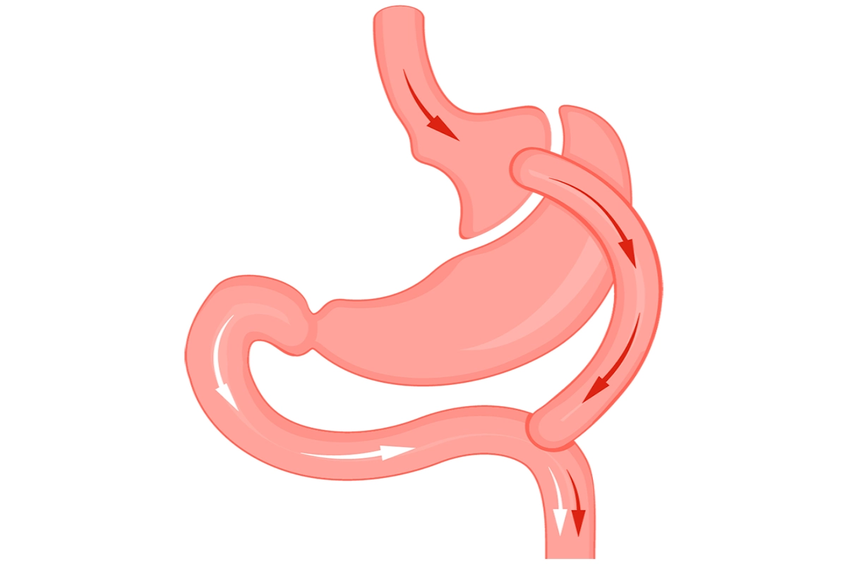 الفرق بين قص المعدة وتحويل المسار