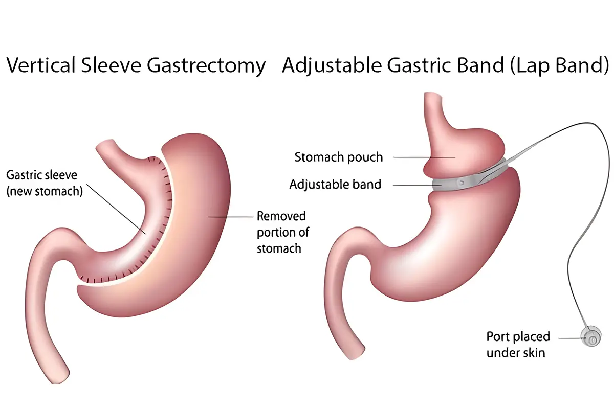 الفرق بين ربط المعدة والتكميم