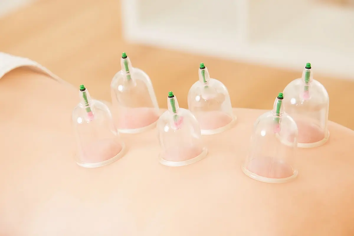 دليل شامل لفوائد الحجامة، معايير السلامة، وأفضل الممارسات العلاجية