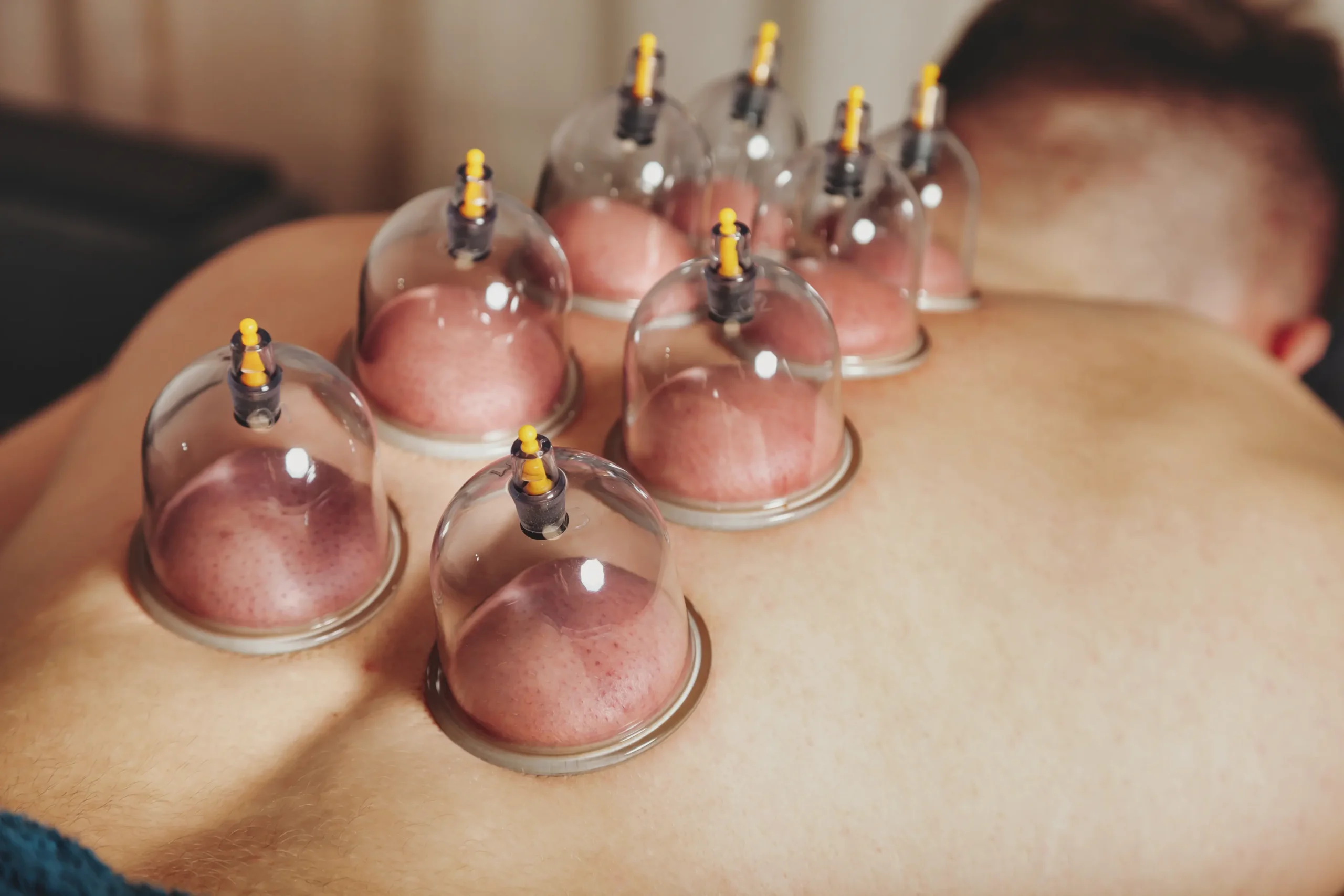 Best Certified Cupping Center in the UAE