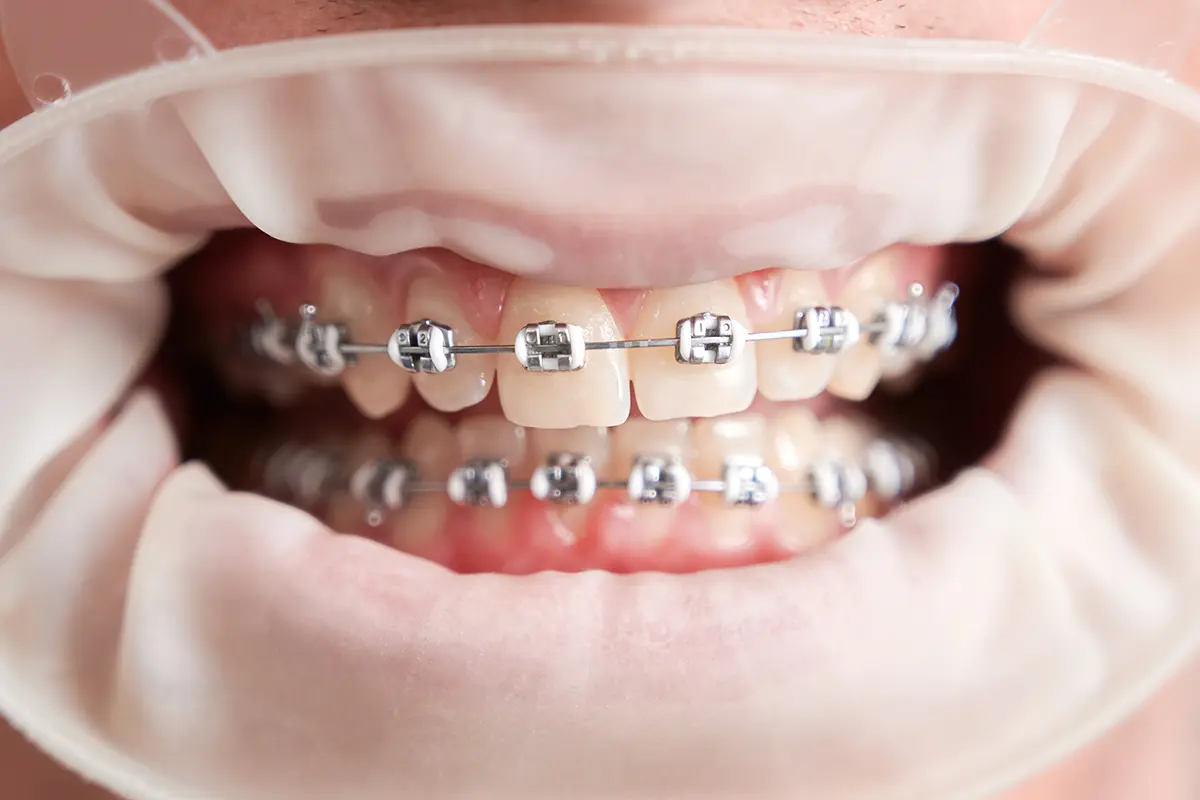 العوامل الرئيسية التي تحدد اسعار تقويم الاسنان في دبي