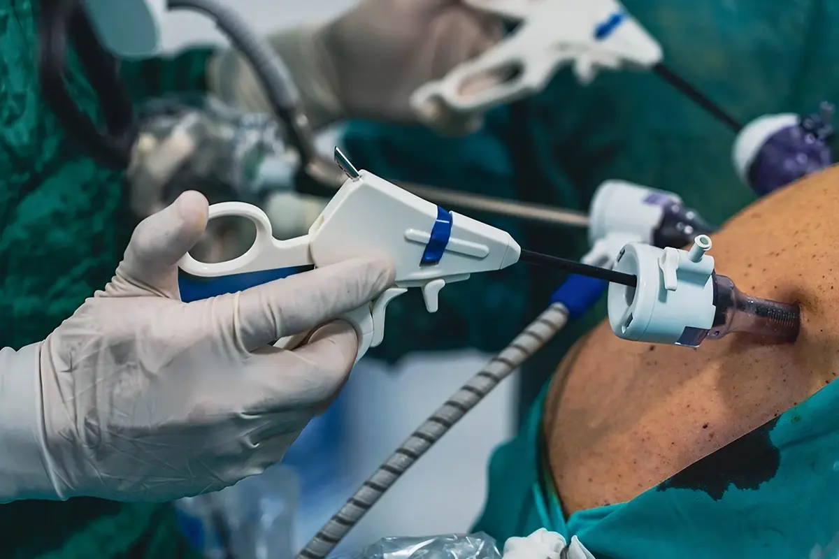 ما الفرق بين التكميم وتحويل المسار؟