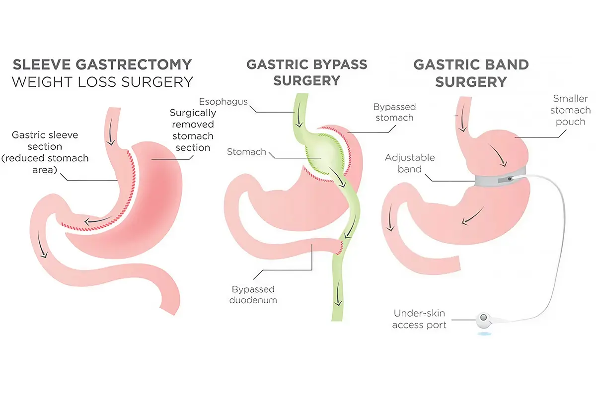 الفرق بين التكميم وتحويل المسار في آلية العمل
