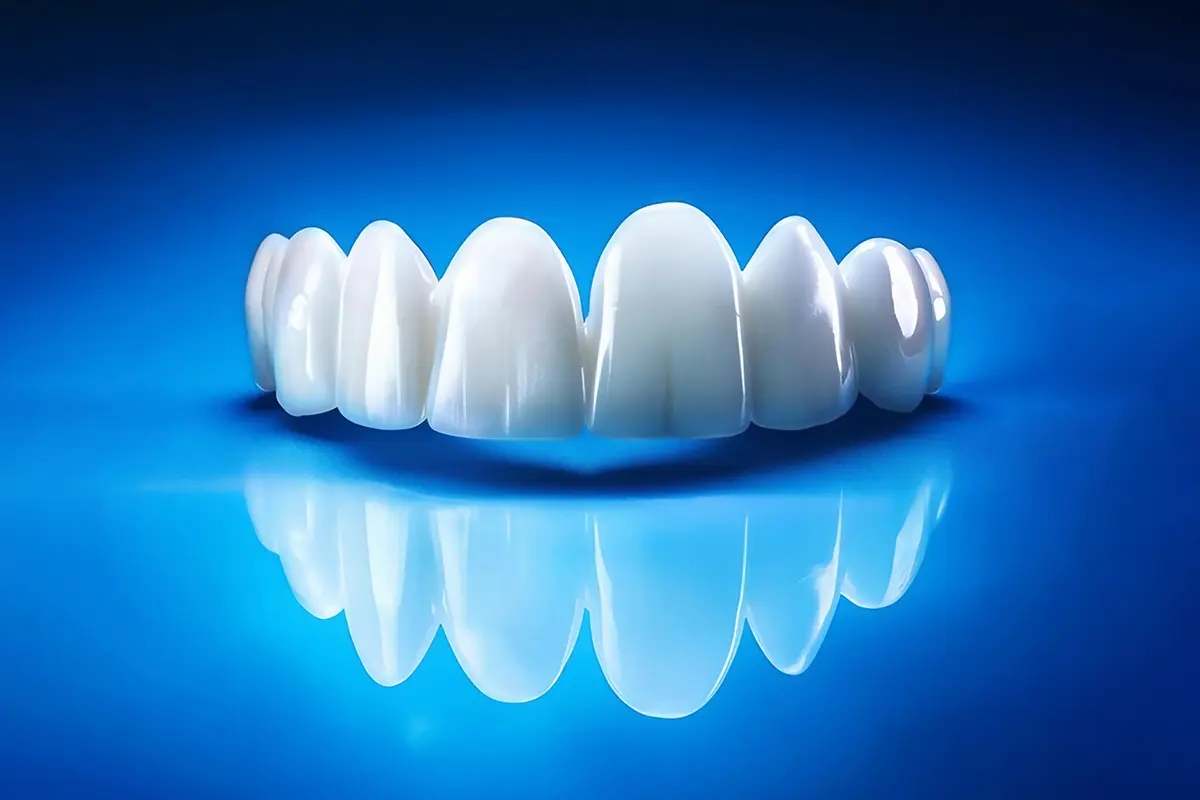 ما هي مميزات الفينير المستخدم في ابتسامة هوليوود في بيوتي وايز؟