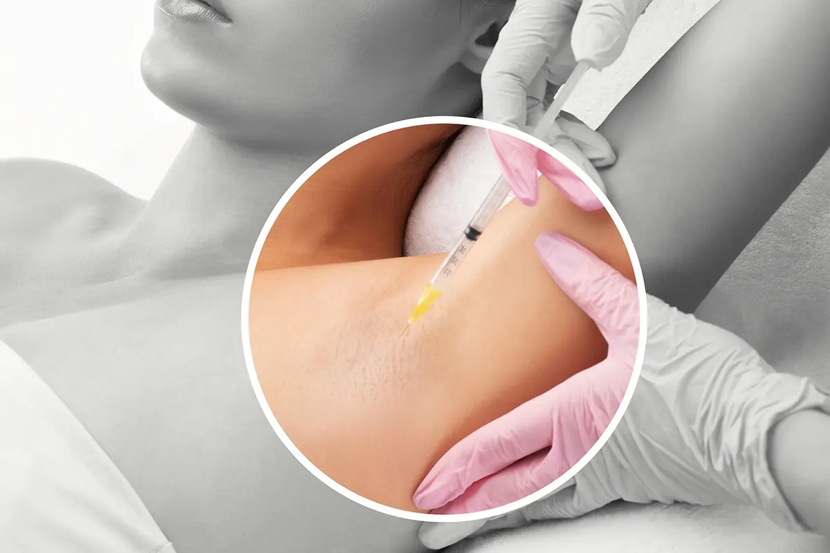 البوتوكس أليرجان فرط التعرق