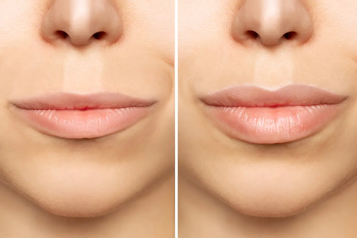 فيلر ريفلوكس في الامارات