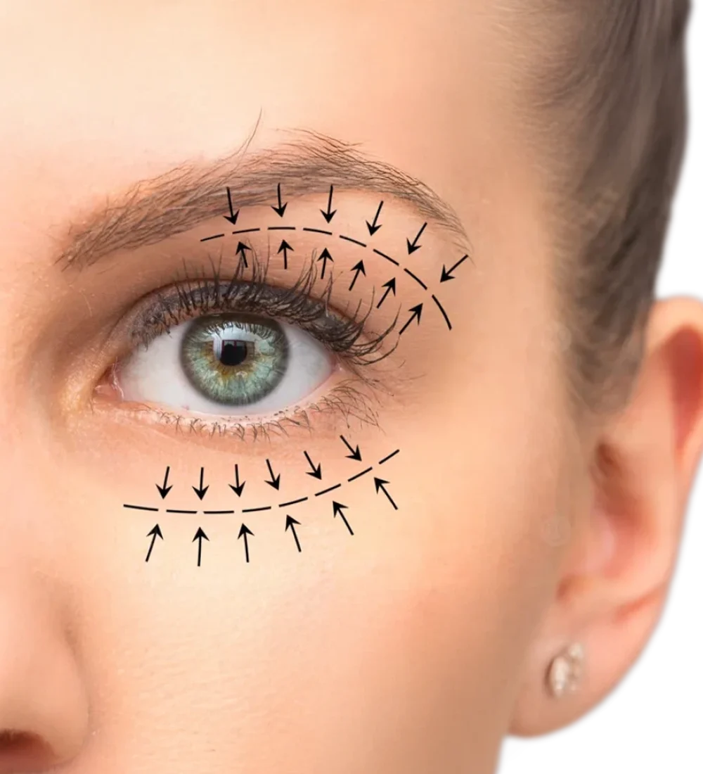 شد الأجفان العلوية والسفلية